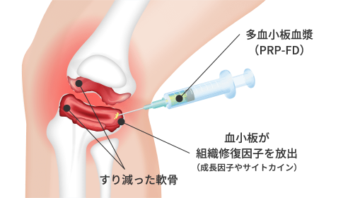 PRP-FD注射はPRPから成長因子のみを抽出し、凍結乾燥（Freeze Dry）することで、さらに高濃度化しておりますので自己治癒力を高める成長因子が、PRP治療の２倍以上含まれています。鎮痛作用や炎症抑制作用、組織修復作用がPRPよりも高いことが最大の特徴です。
