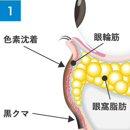 ふくらみだけでなく、凹みや色素沈着も同時に改善
