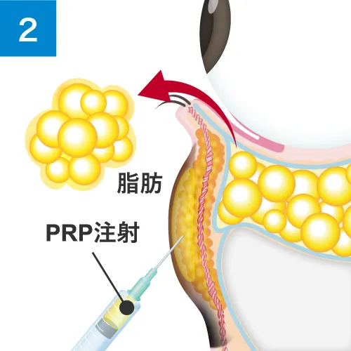 ふくらみだけでなく、凹みや色素沈着も同時に改善