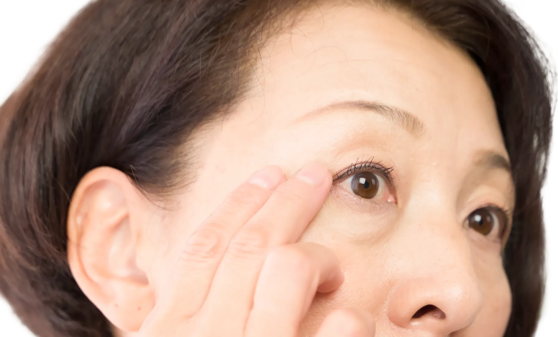 老け顔に見られる目の下のふくらみを取り除いてハリのある若々しい目元に。PRP下眼瞼脱脂術