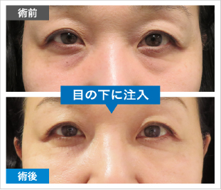 ご自身の血液による肌細胞の再生でシワやほうれい線を改善