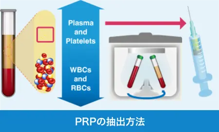 PRPの抽出方法