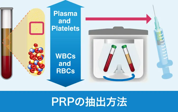 PRPの抽出方法