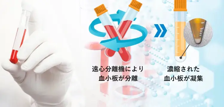 高濃度PRPによる効果の長期間持続