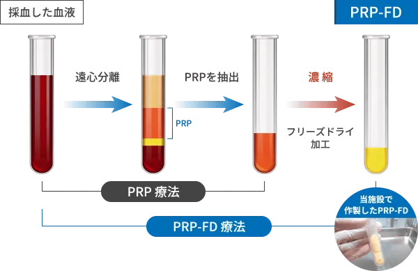 PRP-FD注射はPRPから成長因子のみを抽出し、凍結乾燥（Freeze Dry）することで、さらに高濃度化しておりますので自己治癒力を高める成長因子がPRP注射の２倍以上含まれています。PRP注射は、採血当日にPRP作製から注入まで行うのに比べて、PRP-FD注射は、採血後、一旦血小板に含まれる成長因子だけを抽出、無細胞化した上でフリーズドライ加工する点で、作製には約1週間かかります。PRP-FD注射は、鎮痛作用や炎症抑制作用、組織修復作用がPRP注射よりも高いことが最大の特徴です。