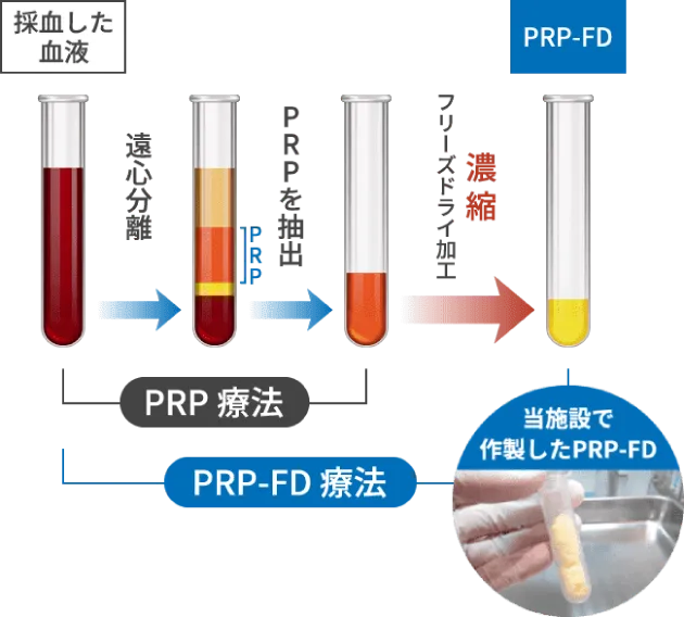 PRP-FD注射はPRPから成長因子のみを抽出し、凍結乾燥（Freeze Dry）することで、さらに高濃度化しておりますので自己治癒力を高める成長因子がPRP注射の２倍以上含まれています。PRP注射は、採血当日にPRP作製から注入まで行うのに比べて、PRP-FD注射は、採血後、一旦血小板に含まれる成長因子だけを抽出、無細胞化した上でフリーズドライ加工する点で、作製には約1週間かかります。PRP-FD注射は、鎮痛作用や炎症抑制作用、組織修復作用がPRP注射よりも高いことが最大の特徴です。