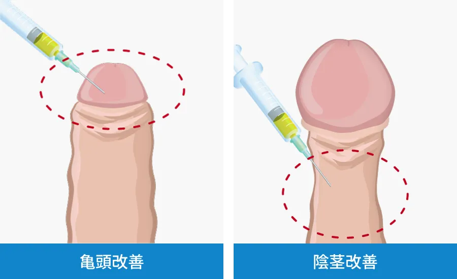 ペニス増大PRPG注射は再生医療です。