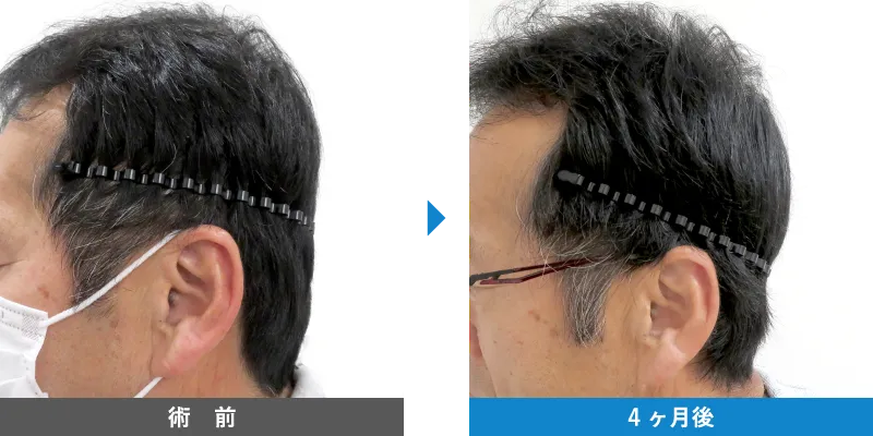 後頭部形成術 症例写真 術前