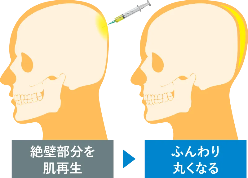 絶壁部分を肌再生⇒ふんわり丸くなる
