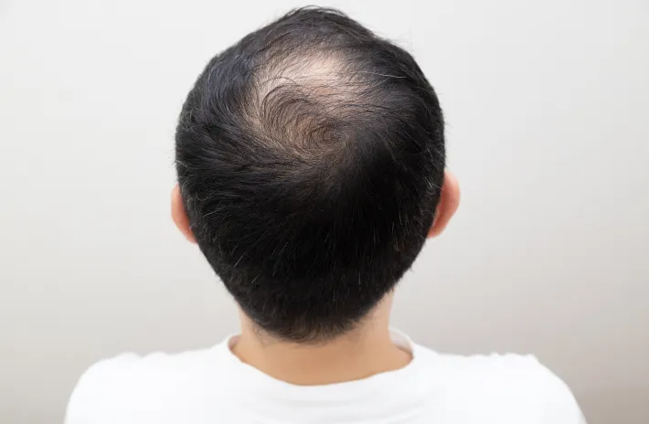 実は男性はもっと深刻。髪が減ってくると絶壁が目立ってしまうため「どうする？もうごまかせない」と悩んでいる方も非常に多いです。ぜひ、お気軽にご相談ください。