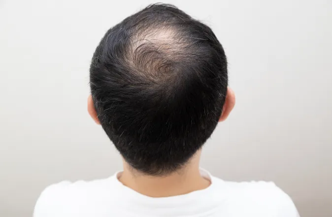 実は男性はもっと深刻。髪が減ってくると絶壁が目立ってしまうため「どうする？もうごまかせない」と悩んでいる方も非常に多いです。ぜひ、お気軽にご相談ください。