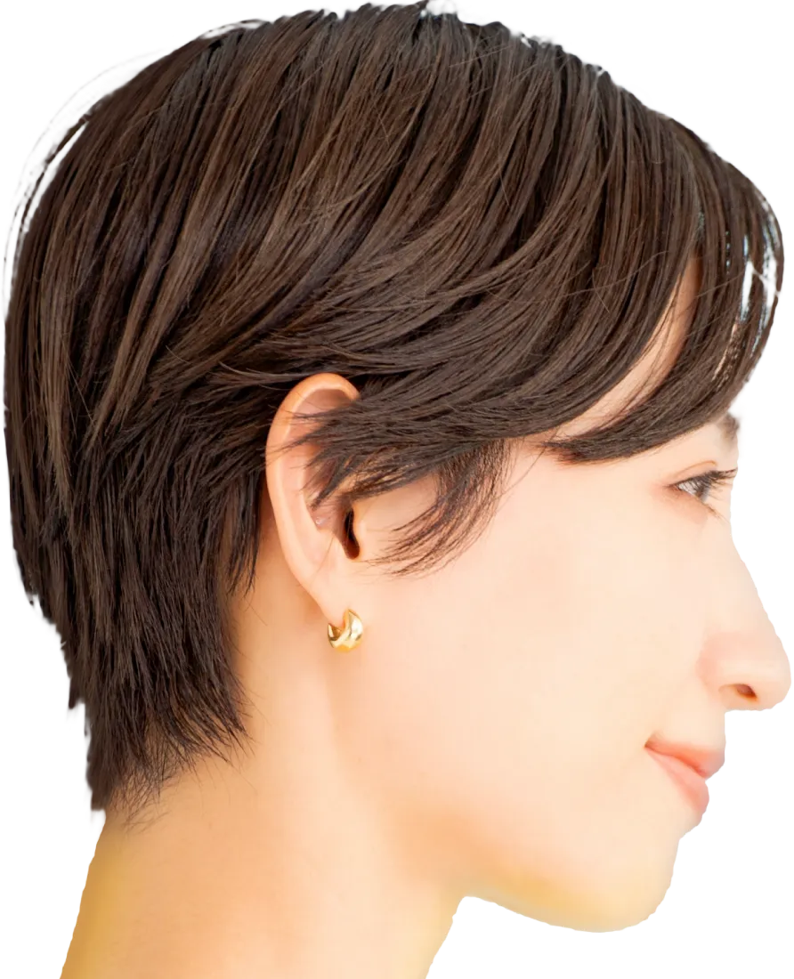 PRPG注入治療による後頭部形成術後頭部のへこみ（絶壁）を解消し美しい横顔に