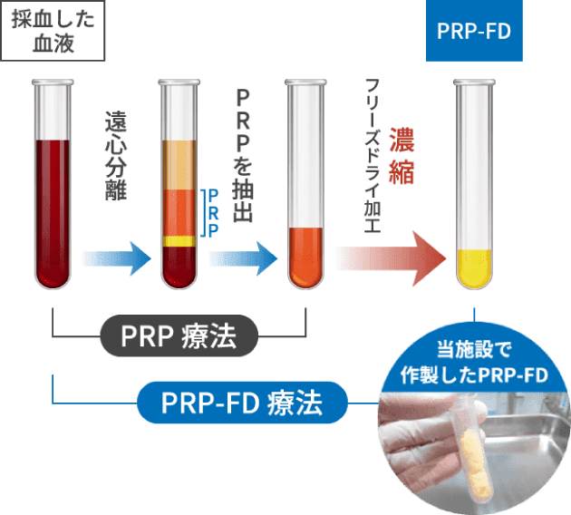 当施設で作成したPRP-FD