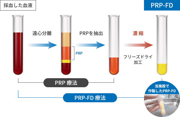 当施設で作成したPRP-FD