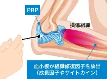 血小板が組織修復因子を放出