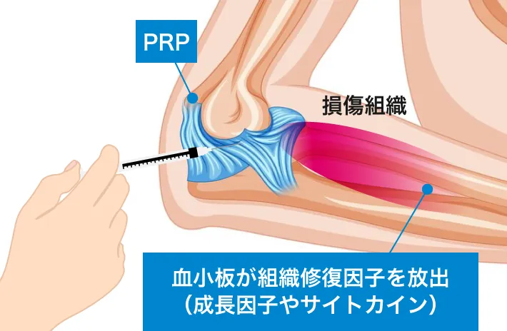 血小板が組織修復因子を放出