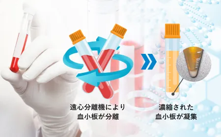高濃度PRPによる効果の長期間持続