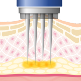 吸引しながら注入するため、しっかり深層部に届きます