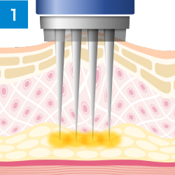 吸引しながら注入するため、しっかり深層部に届きます