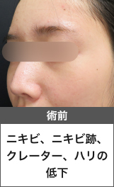 術前：ニキビ、ニキビ跡、クレーター、ハリの低下