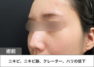術前：ニキビ、ニキビ跡、クレーター、ハリの低下