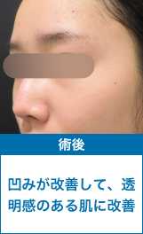 術後：凹みが改善して、透明感のある肌に改善