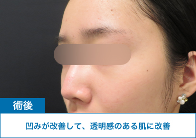 術後：凹みが改善して、透明感のある肌に改善