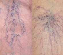 網目状静脈瘤／くもの巣状静脈瘤