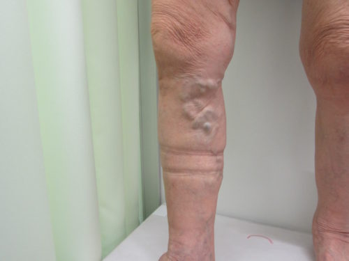 ふくらはぎの静脈瘤