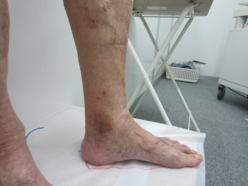 足首の浮き出た血管４