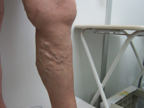 ふくらはぎの静脈瘤