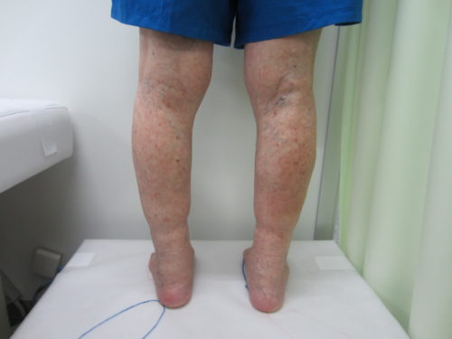 膝裏の静脈瘤写真