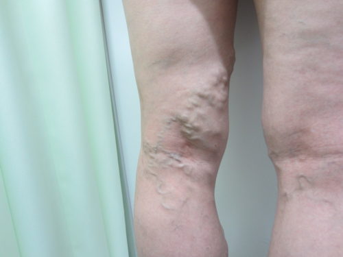膝裏の静脈瘤写真