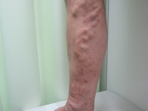 ふくらはぎの静脈瘤