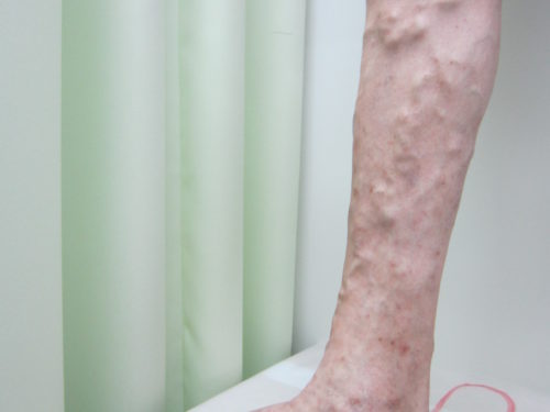 ふくらはぎの静脈瘤