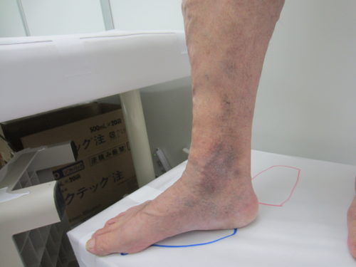 足首の浮き出た血管５