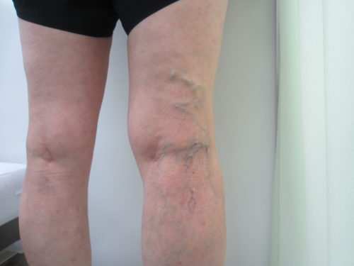 膝裏の静脈瘤写真