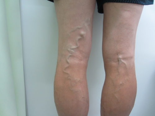 膝裏の静脈瘤写真