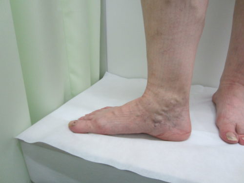 足首の浮き出た血管３