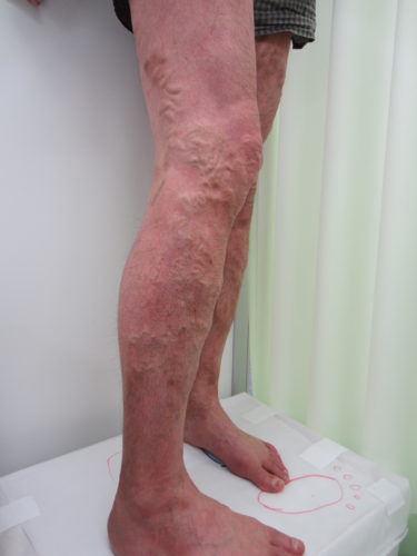 脚の外側の静脈瘤の写真画像