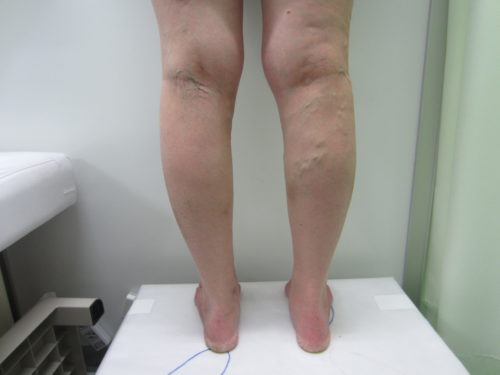 膝裏の静脈瘤写真