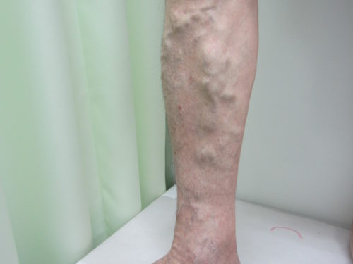 ふくらはぎの静脈瘤