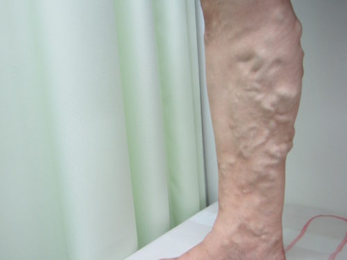 ふくらはぎの静脈瘤