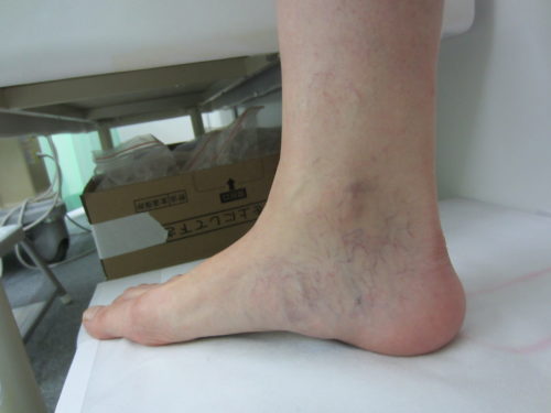 足首の浮き出た血管１