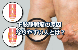 下肢静脈瘤の原因としくみについてわかりやすく解説。下肢静脈瘤になりやすい人とは？