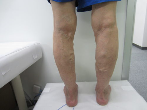 膝裏の静脈瘤写真