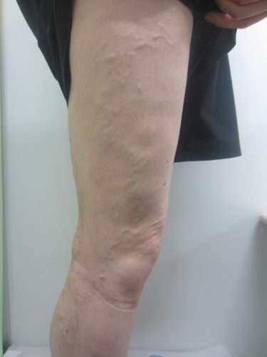 脚の外側の静脈瘤の写真画像