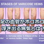 足の血管がボコボコ浮き出る透けて見える病気とは