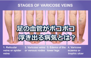 足の血管が目立つ「ボコボコ浮き出る・透けて見える」病気とは！？