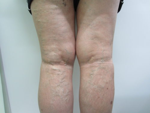 膝裏の静脈瘤写真